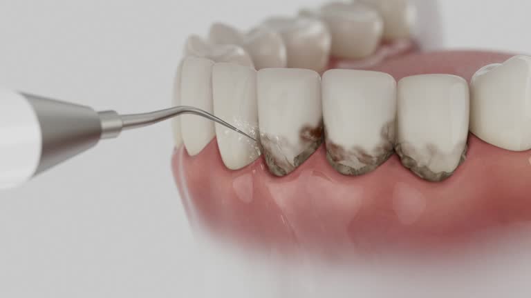 Trusted Wisdom Tooth Removal service in Simpson, PA - Dentist Open Now